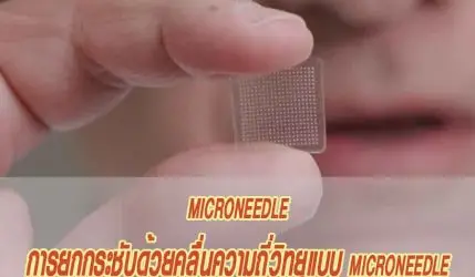 microneedle การยกกระชับด้วยคลื่นความถี่วิทยุแบบ microneedle